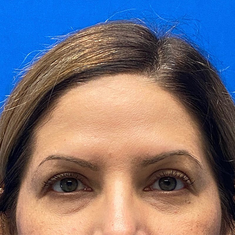 Brow Lift Before & After Gallery - Patient 122922204 - Image 1