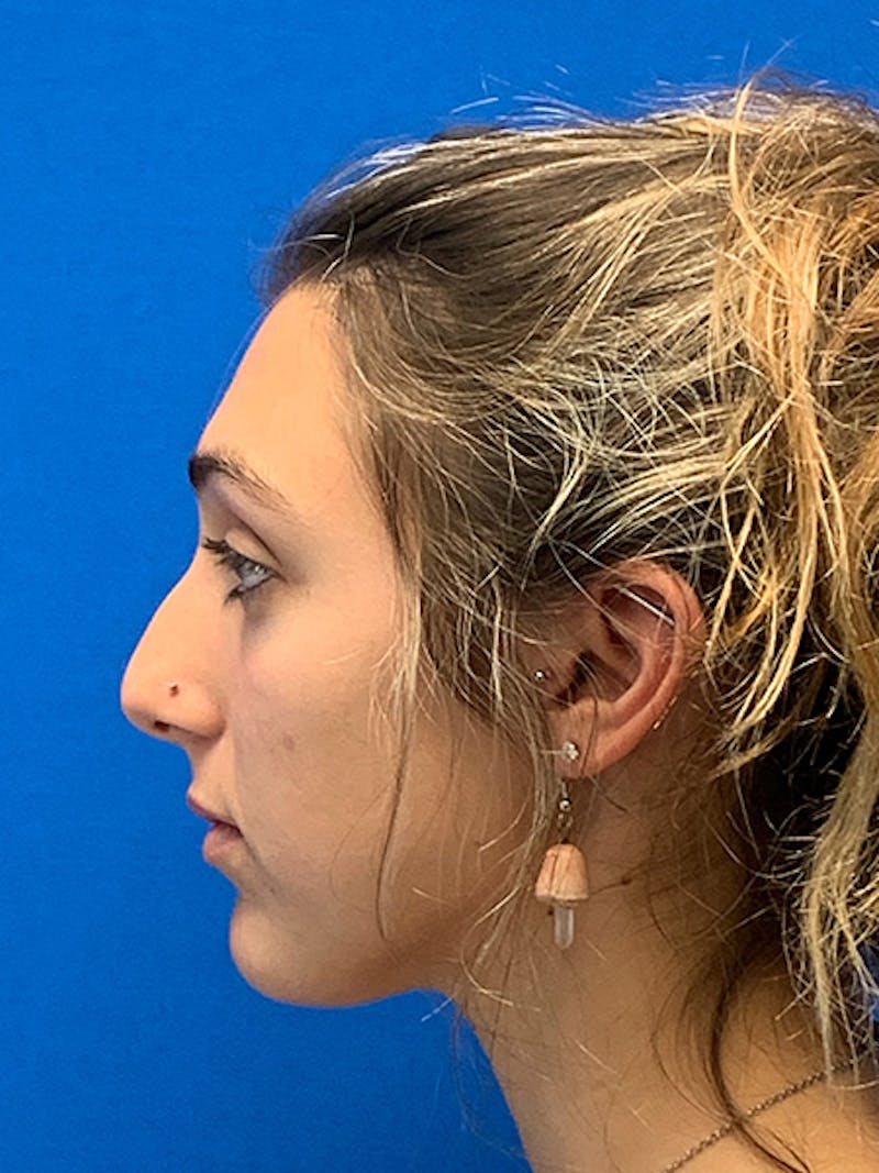 Rhinoplasty Before & After Gallery - Patient 122922198 - Image 9