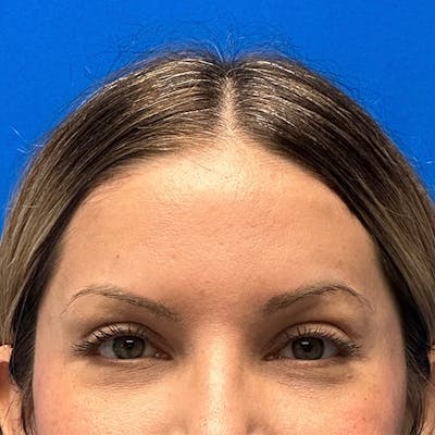 Brow Lift Before & After Gallery - Patient 122922204 - Image 2