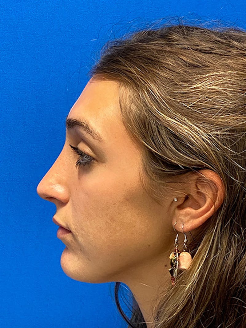 Rhinoplasty Before & After Gallery - Patient 122922198 - Image 10