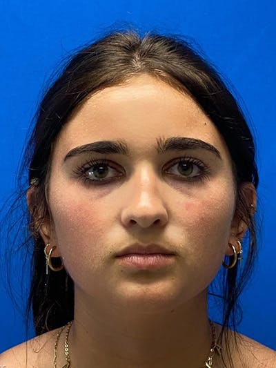Rhinoplasty Before & After Gallery - Patient 122922226 - Image 1