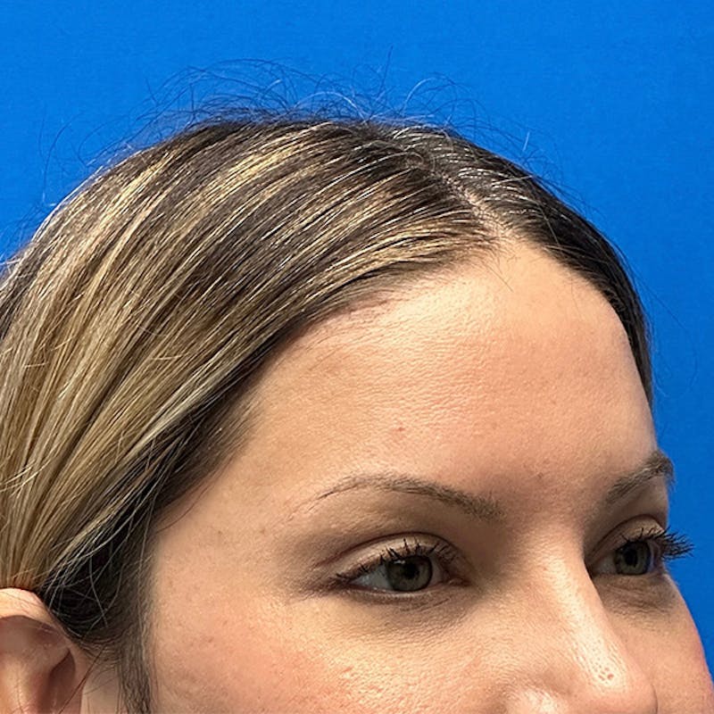 Brow Lift Before & After Gallery - Patient 122922204 - Image 4