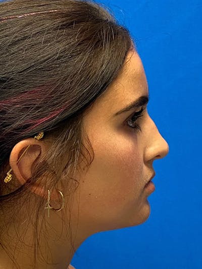 Primary Rhinoplasty Before & After Gallery - Patient 122922226 - Image 1