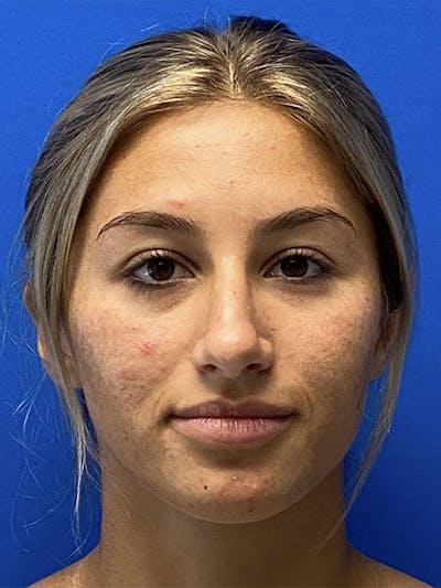 Primary Rhinoplasty Before & After Gallery - Patient 122922257 - Image 1