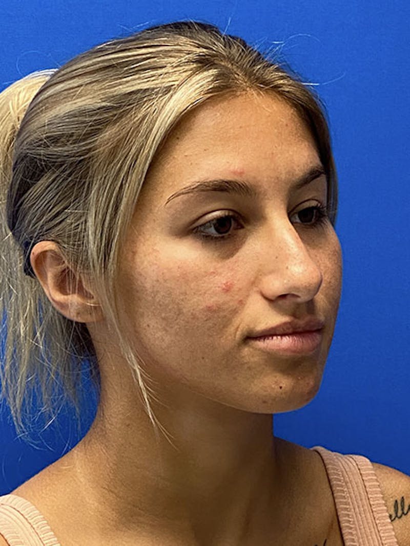 Rhinoplasty Before & After Gallery - Patient 122922257 - Image 3