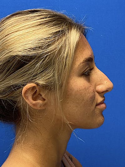 Primary Rhinoplasty Before & After Gallery - Patient 122922257 - Image 1