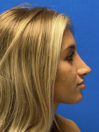 Primary Rhinoplasty Before & After Gallery - Patient 122922257 - Image 2