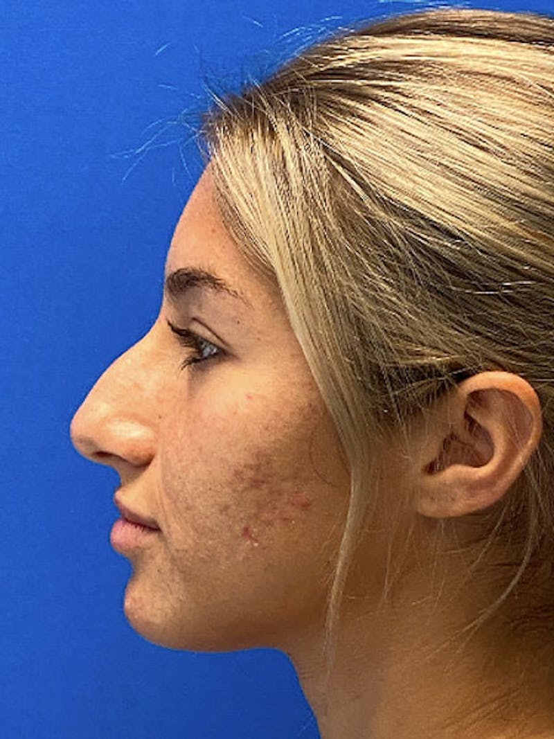 Primary Rhinoplasty Before & After Gallery - Patient 122922257 - Image 7