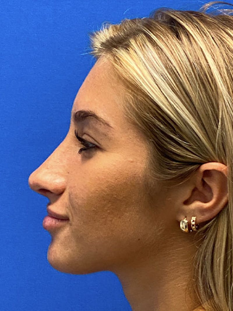 Primary Rhinoplasty Before & After Gallery - Patient 122922257 - Image 8