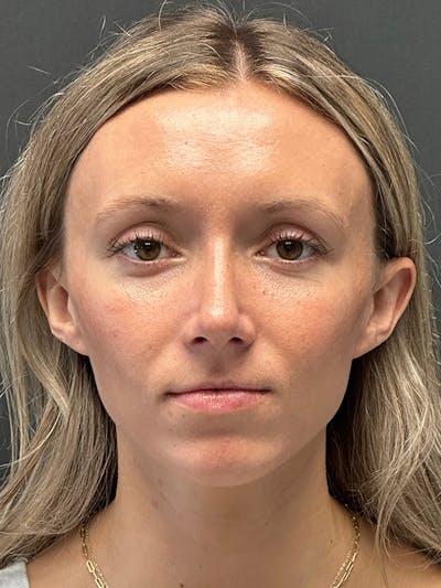 Chin Augmentation Before & After Gallery - Patient 122922285 - Image 2
