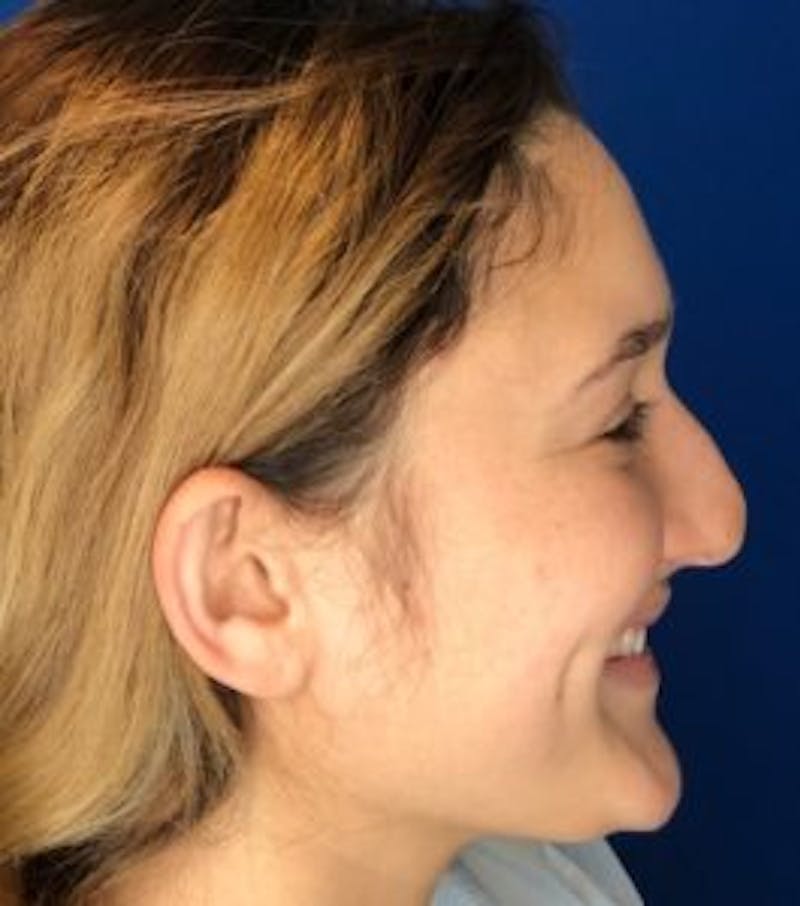 Primary Rhinoplasty Before & After Gallery - Patient 122922317 - Image 7