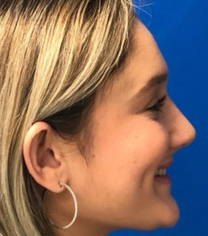 Rhinoplasty Before & After Gallery - Patient 122922317 - Image 8