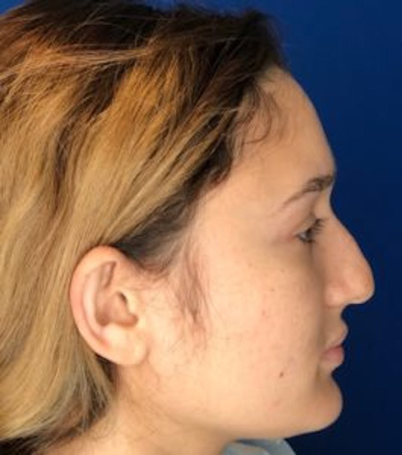 Primary Rhinoplasty Before & After Gallery - Patient 122922317 - Image 9