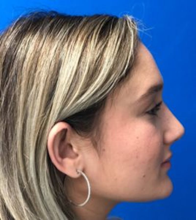 Rhinoplasty Before & After Gallery - Patient 122922317 - Image 10