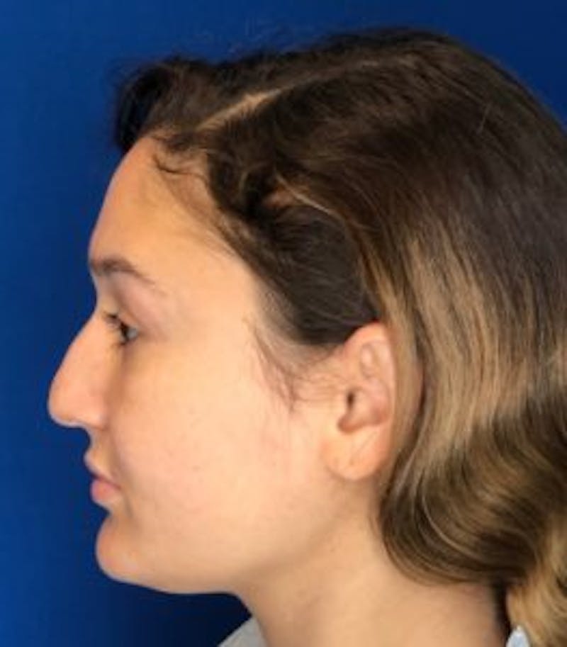 Rhinoplasty Before & After Gallery - Patient 122922317 - Image 13