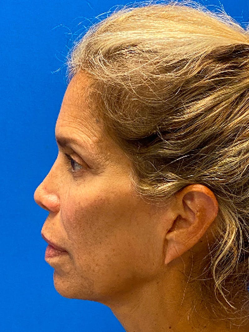 Facial Fat Grafting Before & After Gallery - Patient 122922333 - Image 5