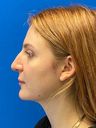 Primary Rhinoplasty Before & After Gallery - Patient 122922348 - Image 1