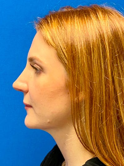 Primary Rhinoplasty Before & After Gallery - Patient 122922348 - Image 2