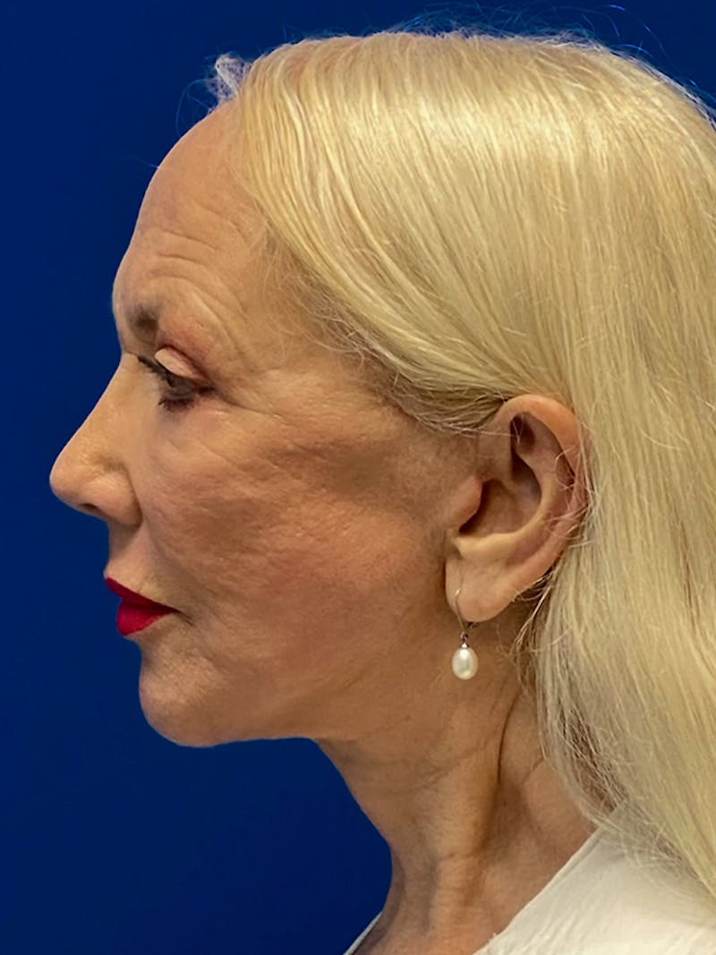 Facial Fat Grafting Before & After Gallery - Patient 122922353 - Image 6