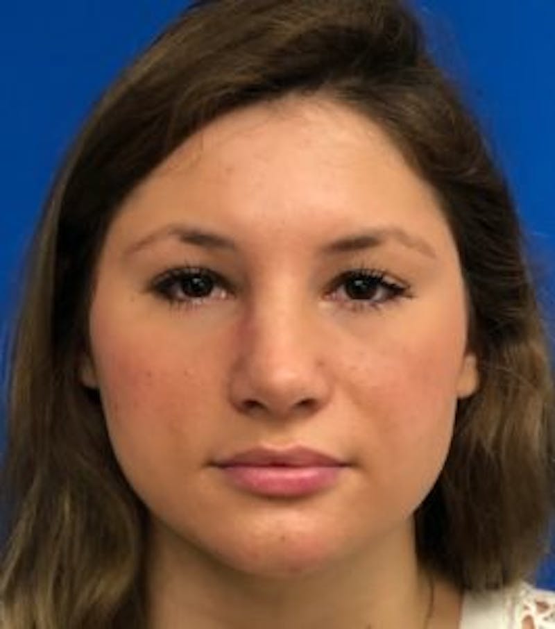 Primary Rhinoplasty Before & After Gallery - Patient 122924088 - Image 4