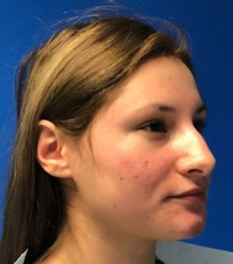 Primary Rhinoplasty Before & After Gallery - Patient 122924088 - Image 5