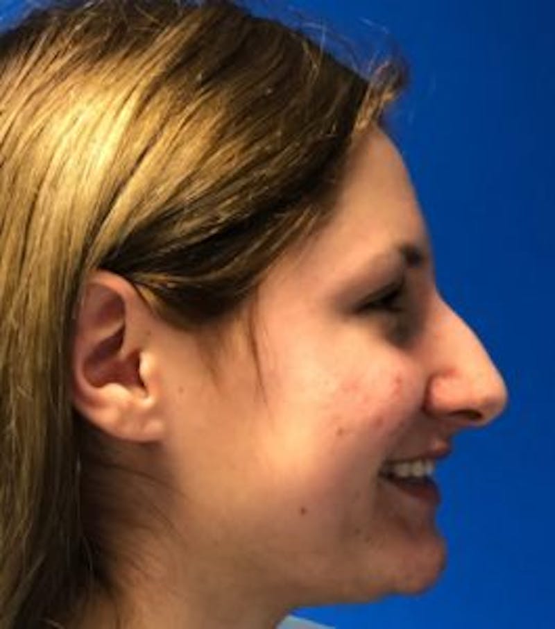 Primary Rhinoplasty Before & After Gallery - Patient 122924088 - Image 9
