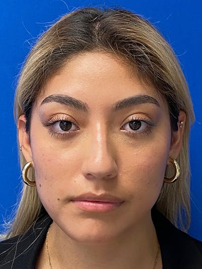 Rhinoplasty Before & After Gallery - Patient 122925319 - Image 1