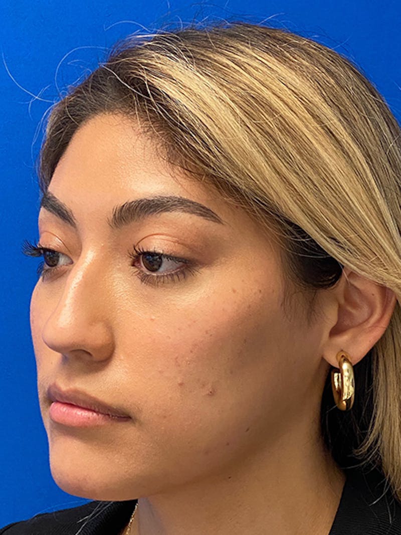 Primary Rhinoplasty Before & After Gallery - Patient 122925319 - Image 3