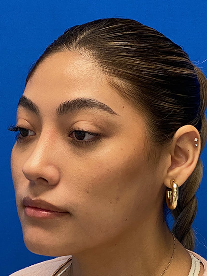 Primary Rhinoplasty Before & After Gallery - Patient 122925319 - Image 4