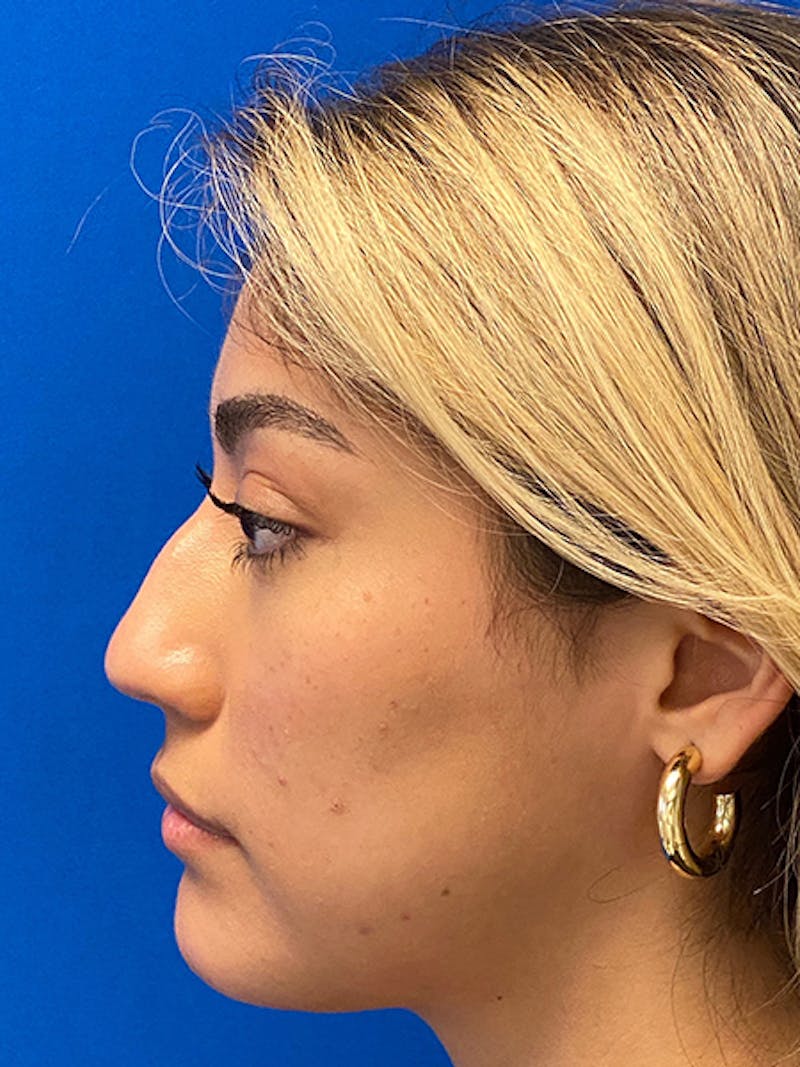 Primary Rhinoplasty Before & After Gallery - Patient 122925319 - Image 5