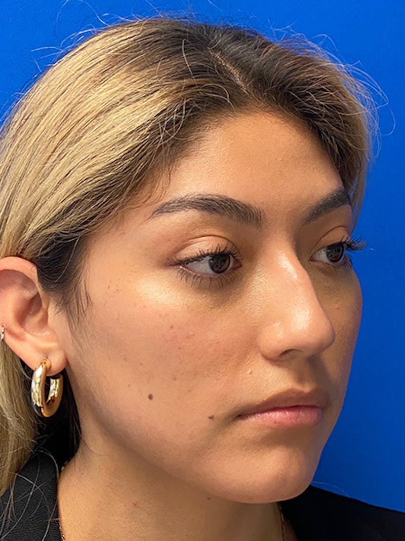 Primary Rhinoplasty Before & After Gallery - Patient 122925319 - Image 7