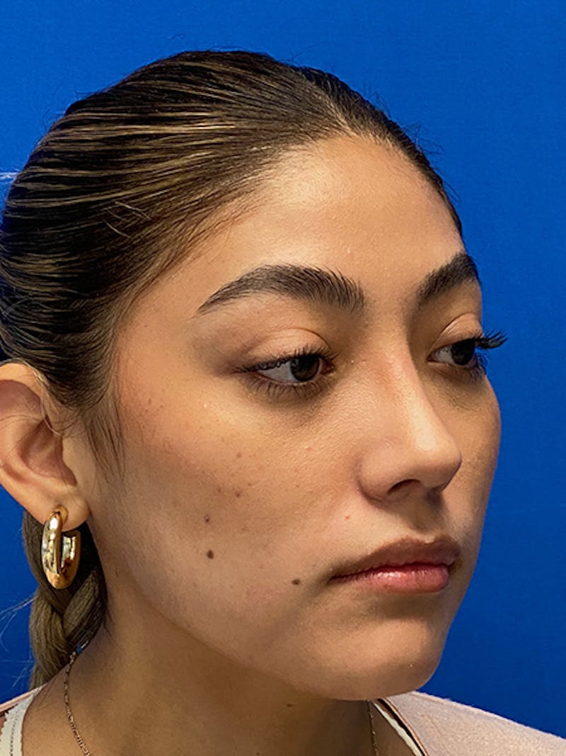 Rhinoplasty Before & After Gallery - Patient 122925319 - Image 8