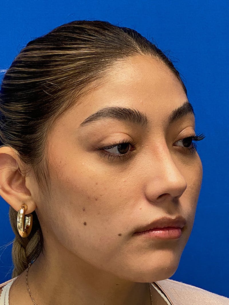 Primary Rhinoplasty Before & After Gallery - Patient 122925319 - Image 8