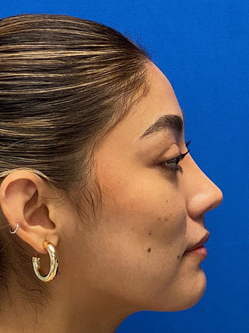 Rhinoplasty Before & After Gallery - Patient 122925319 - Image 10