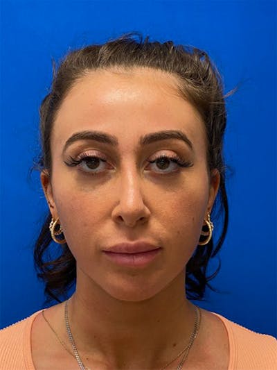 Primary Rhinoplasty Before & After Gallery - Patient 122925363 - Image 1
