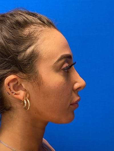 Primary Rhinoplasty Before & After Gallery - Patient 122925363 - Image 1