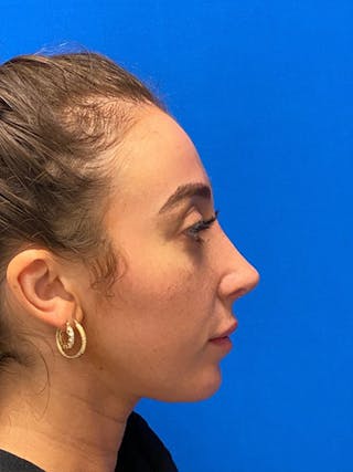 Primary Rhinoplasty Before & After Gallery - Patient 122925363 - Image 2