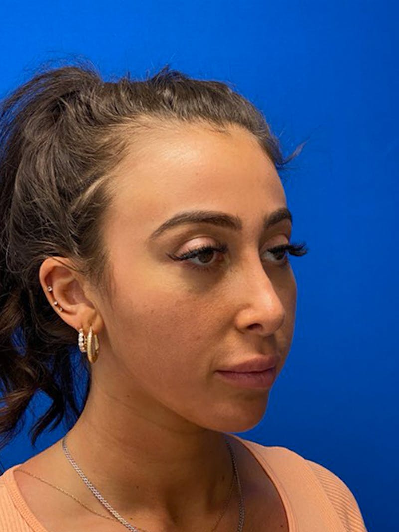 Primary Rhinoplasty Before & After Gallery - Patient 122925363 - Image 9