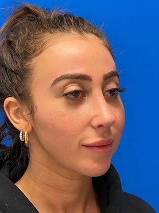 Primary Rhinoplasty Before & After Gallery - Patient 122925363 - Image 10