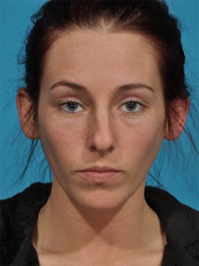 Primary Rhinoplasty Before & After Gallery - Patient 122925376 - Image 1