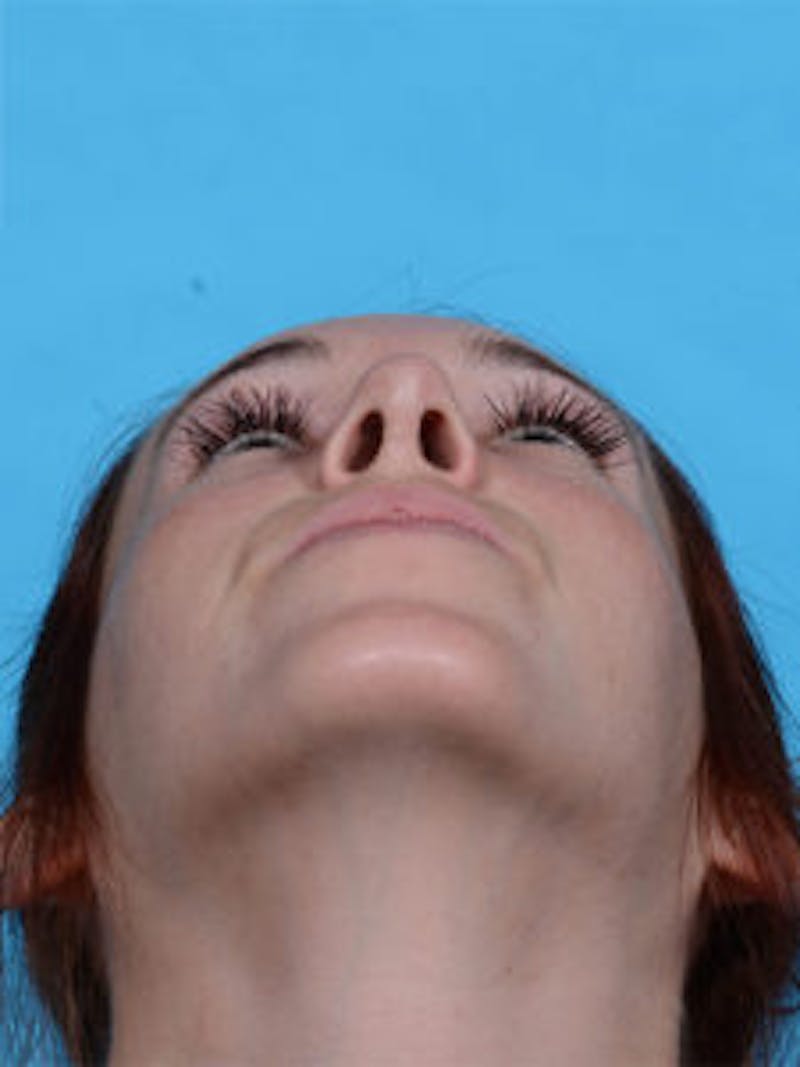 Rhinoplasty Before & After Gallery - Patient 122925376 - Image 4