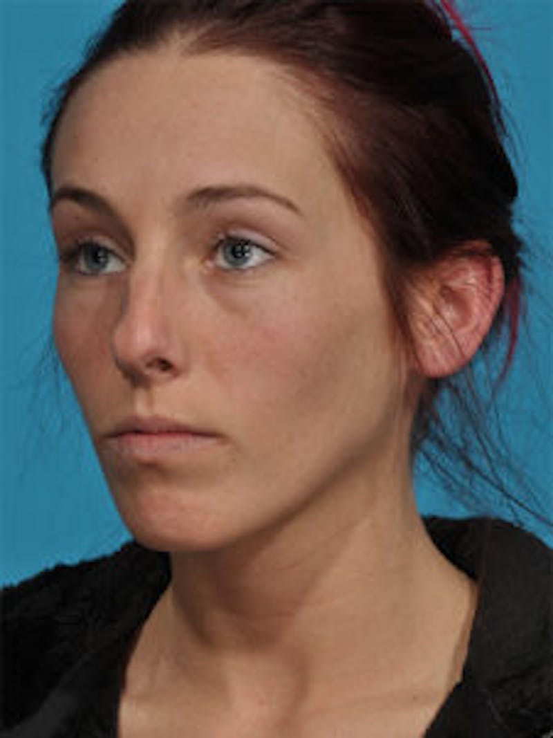 Rhinoplasty Before & After Gallery - Patient 122925376 - Image 7