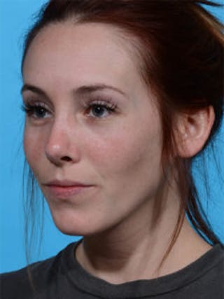 Primary Rhinoplasty Before & After Gallery - Patient 122925376 - Image 8