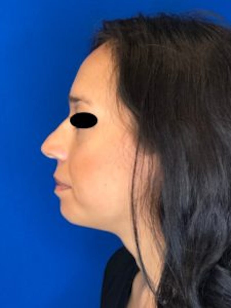 Rhinoplasty Before & After Gallery - Patient 122925392 - Image 3