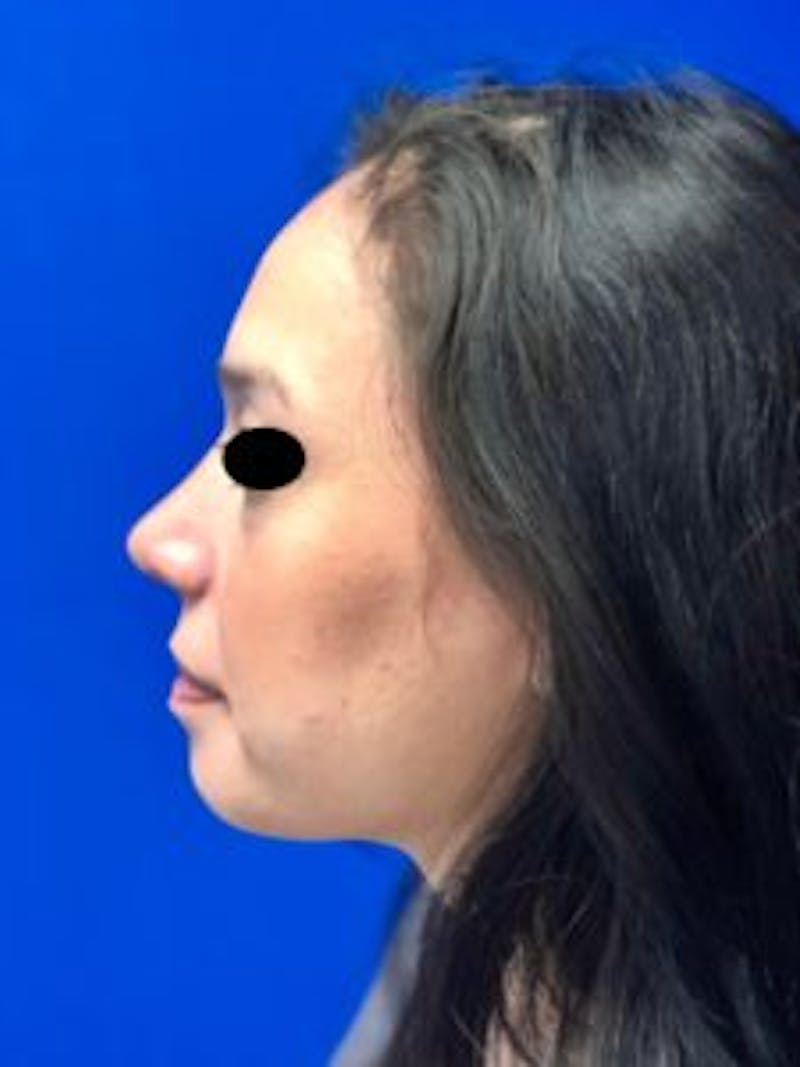 Rhinoplasty Before & After Gallery - Patient 122925392 - Image 4
