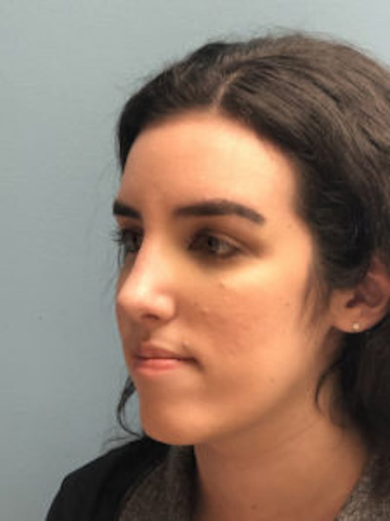Rhinoplasty Before & After Gallery - Patient 122925432 - Image 4