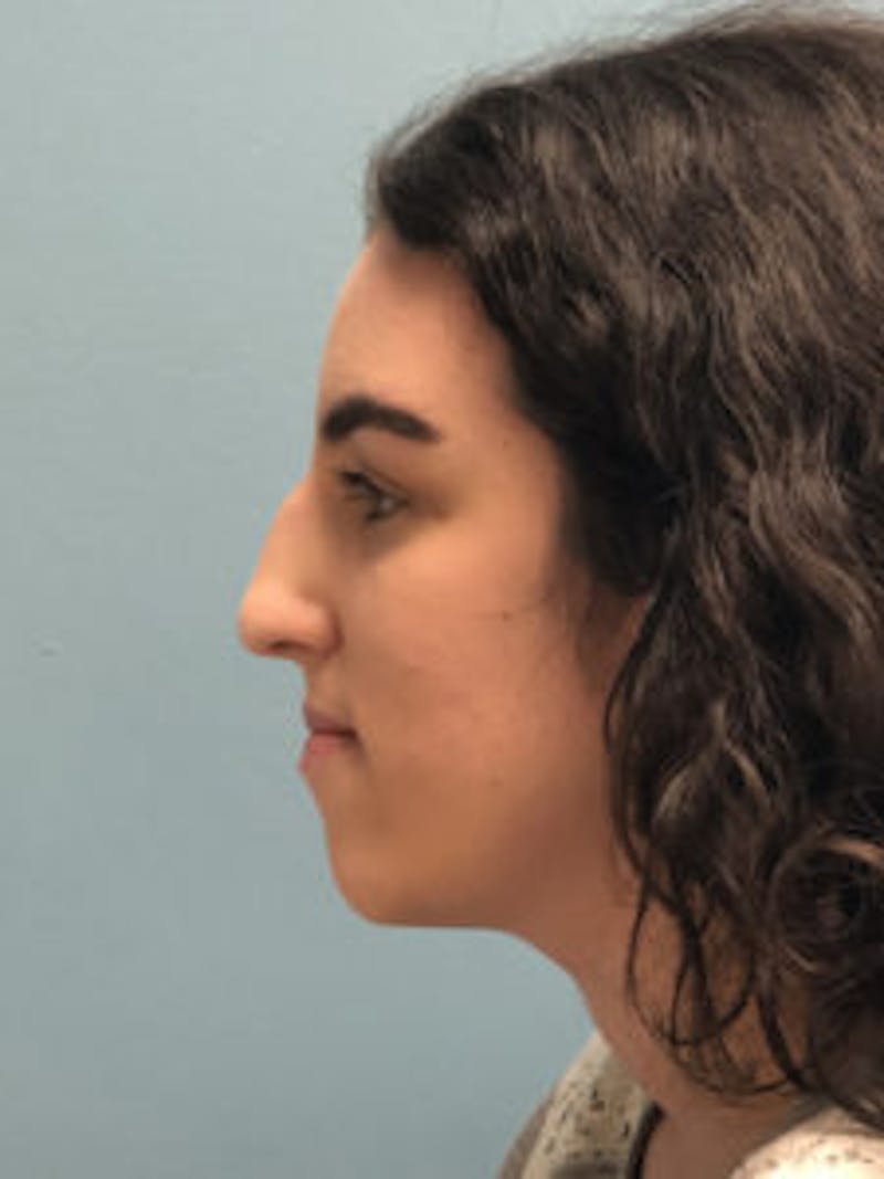 Primary Rhinoplasty Before & After Gallery - Patient 122925432 - Image 5