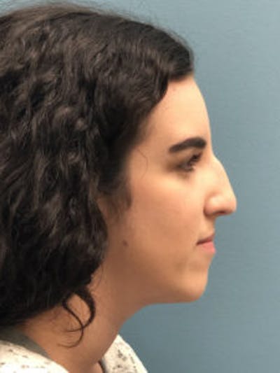 Primary Rhinoplasty Before & After Gallery - Patient 122925432 - Image 1
