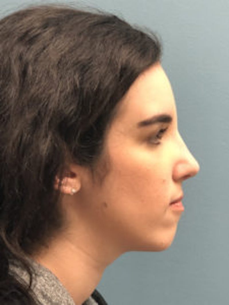 Rhinoplasty Before & After Gallery - Patient 122925432 - Image 10