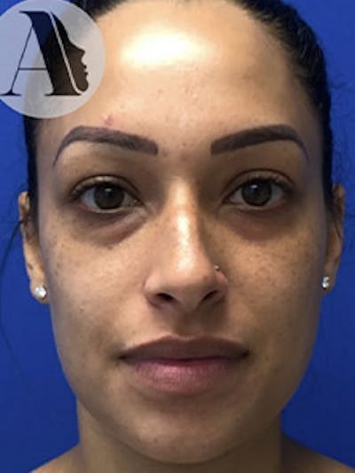 Primary Rhinoplasty Before & After Gallery - Patient 122925464 - Image 1
